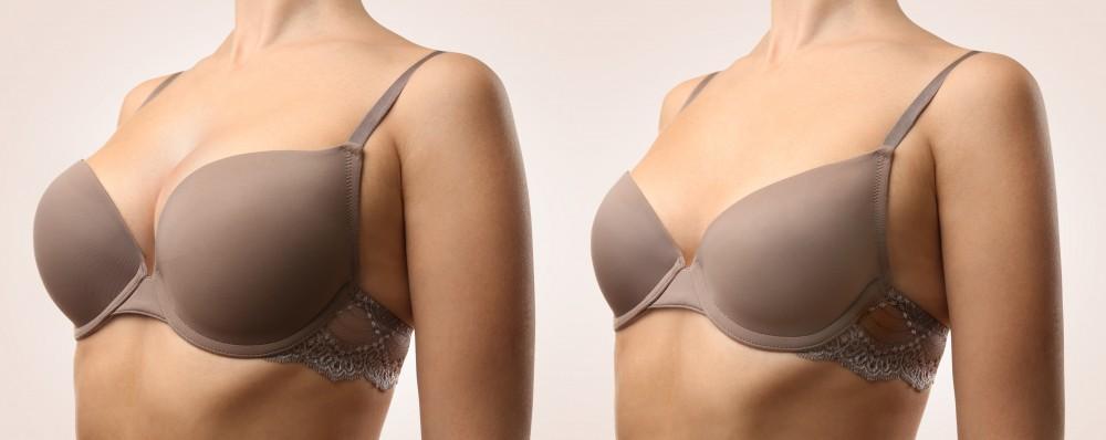 Brustvergrößerung mit Eigenfett: Der doppelte Nutzen für Körperkontur und Brustvolumen